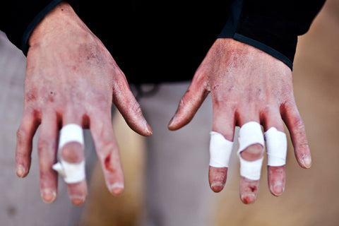 Cracked and Bleeding Taped Climber Hands