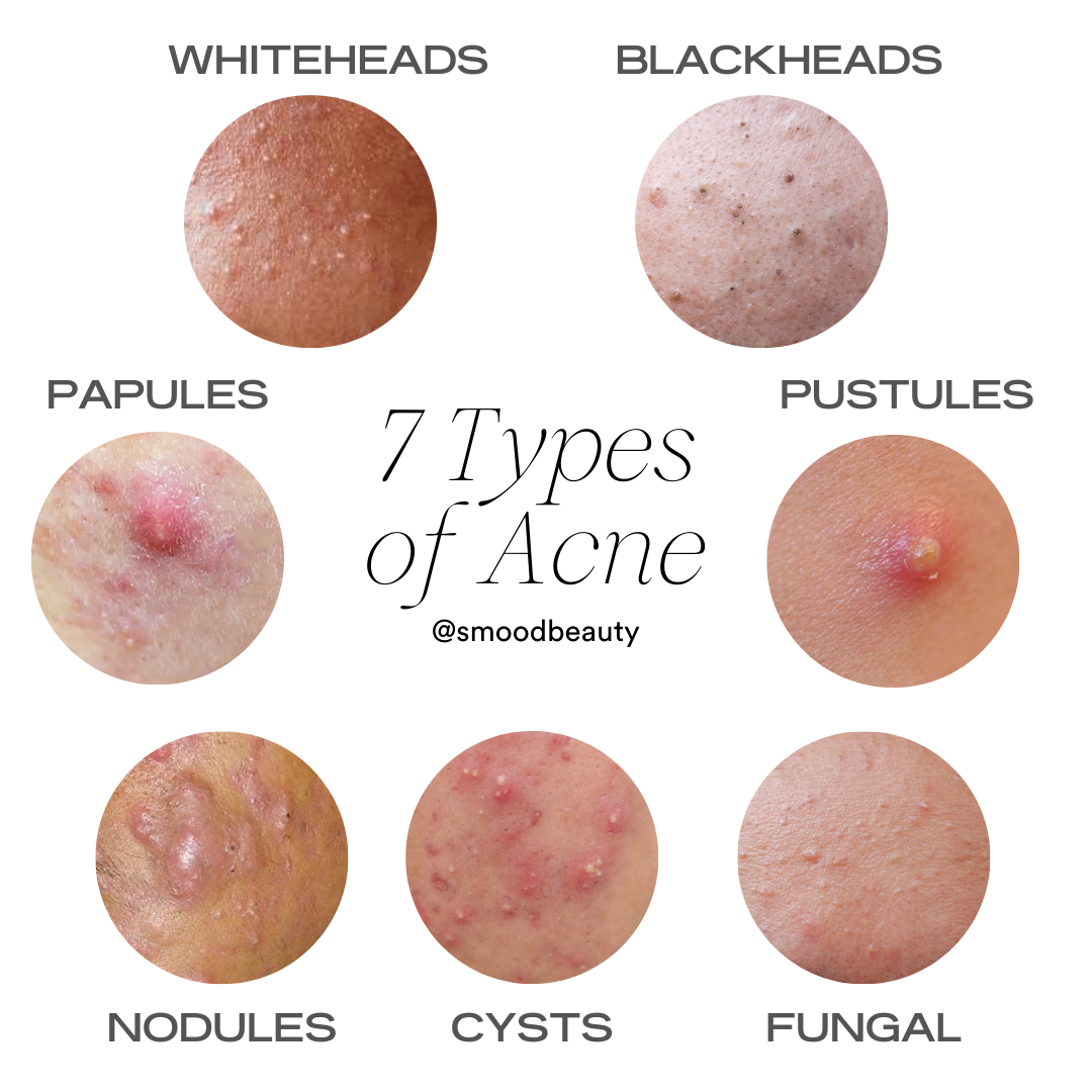 Images of the 7 different types of acne