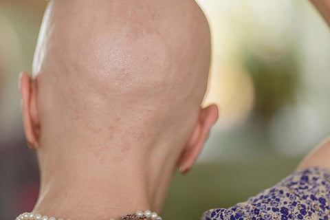 Back view of alopecia totalis