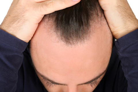 Misconceptions About Widow's Peak