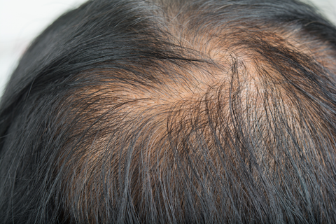 Signs Of Protein Deficiency In Hair