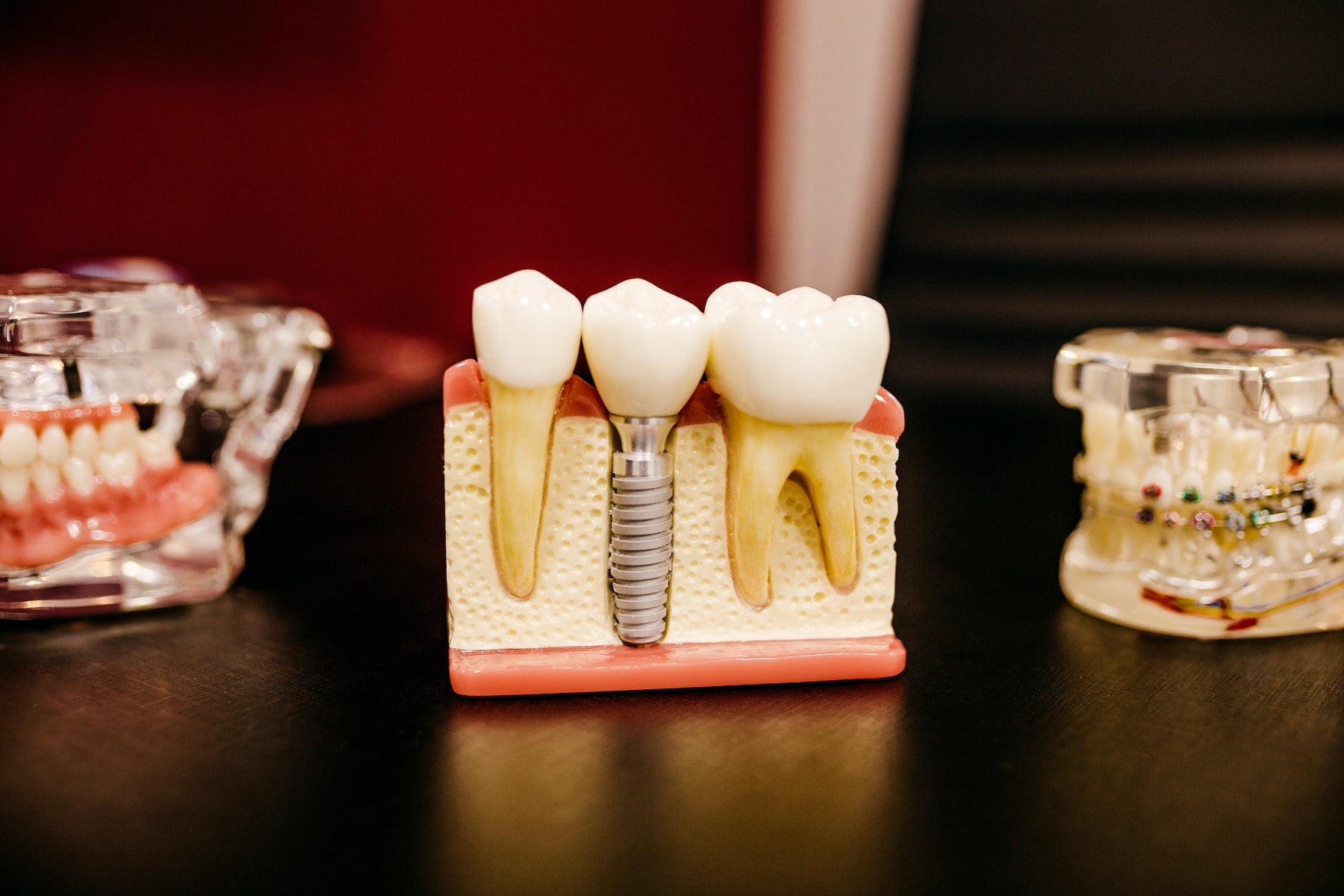 Tooth implant model