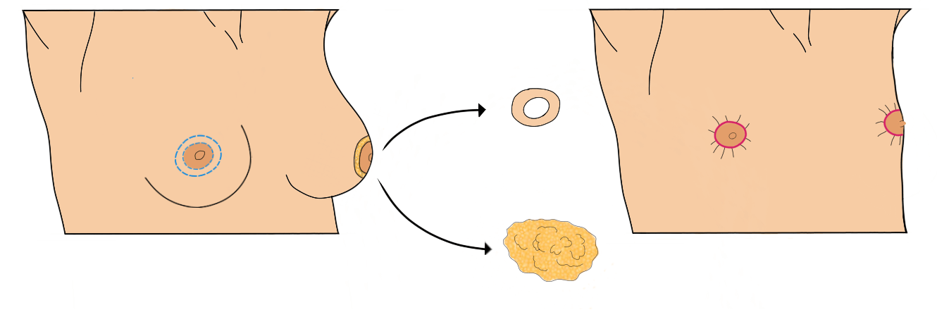 Donut procedure