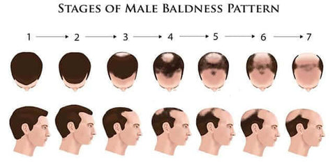 FTM male pattern baldness