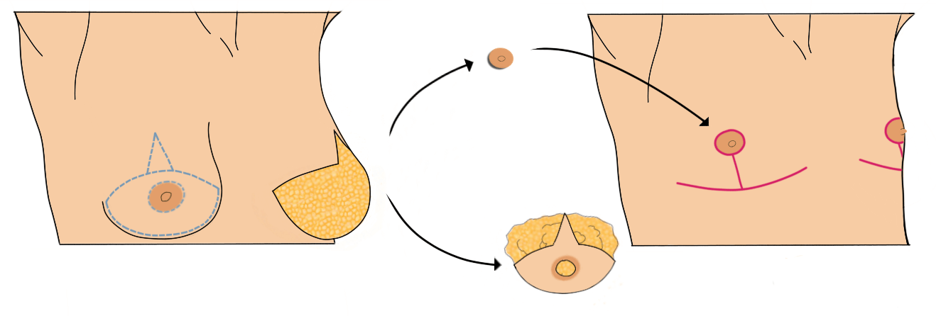 FTM inverted-T or T-anchor top surgery