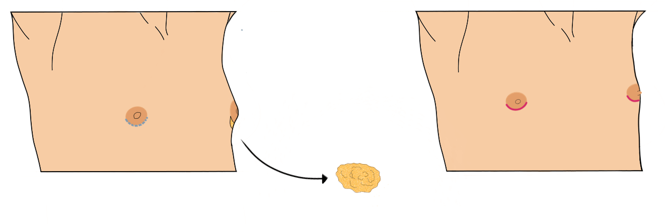 Keyhole top surgery