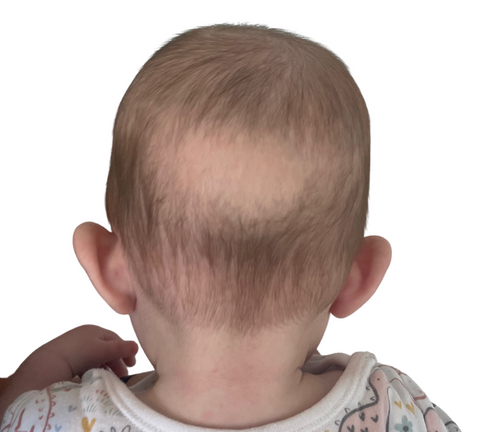 How to prevent the baby bald patch