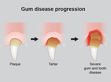 Periodontal Disease in dogs