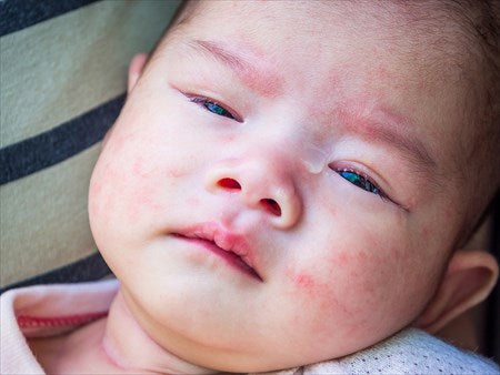 新生児の顔のかぶれにも低刺激な保湿クリームを 乳児湿疹について Holo