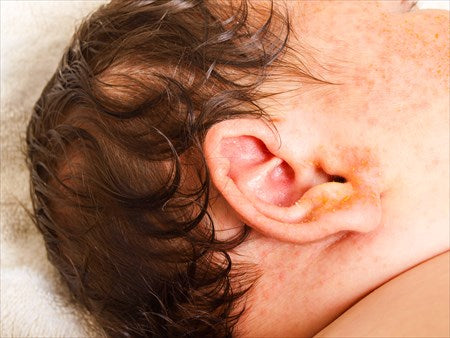 赤ちゃんの汗疹の種類