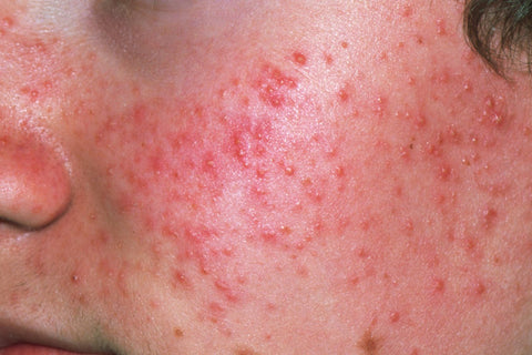 Imagem de uma parte do rosto de uma pessoa com espinha e acne de grau 2, ou seja, espinha avermelhadas. 