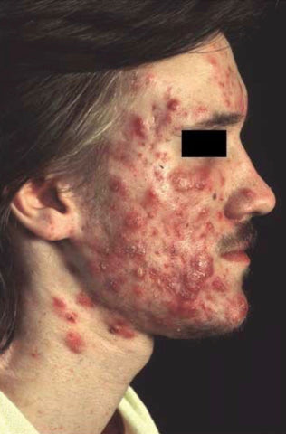 Imagem de um homem com a pele do rosto com acne de grau III, com muitas espinhas vermelhas, cravos e espinhas com pus.  