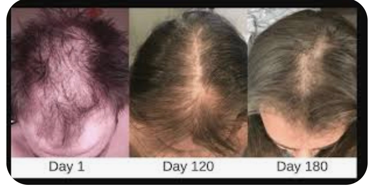A high tech grow light for your hair Infrared light therapy offers a  seamless way to enhance your look and reverse hair loss Its safe each  session is only 20 minutes and its especially effective for women whose  hair is thinning along the center part or at the 