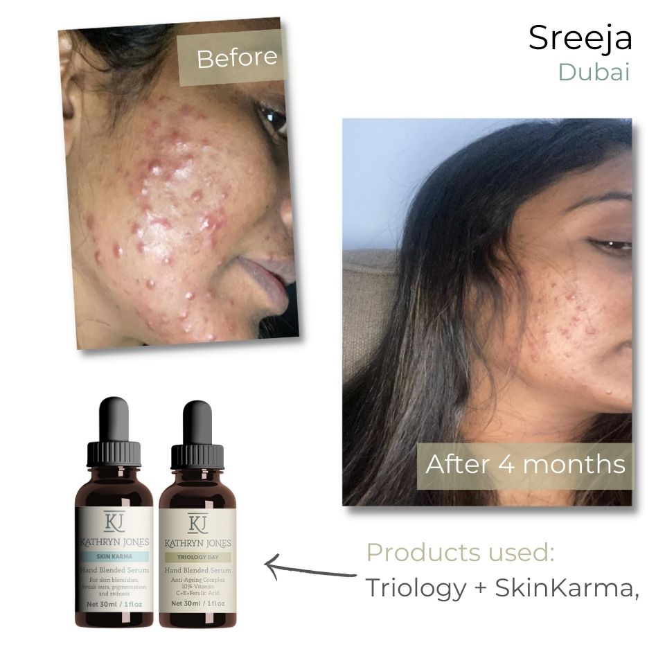 ACNE Shopping - Buy Natural Products for ACNE Skin - KJ Serums