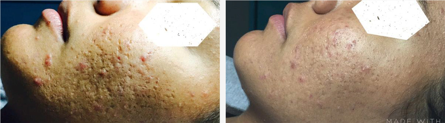 Acne Treatment Before/After