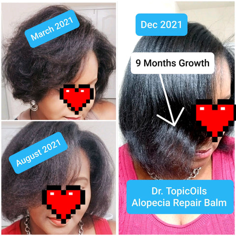 Dr. TopicOils Alopecia Repair Balm