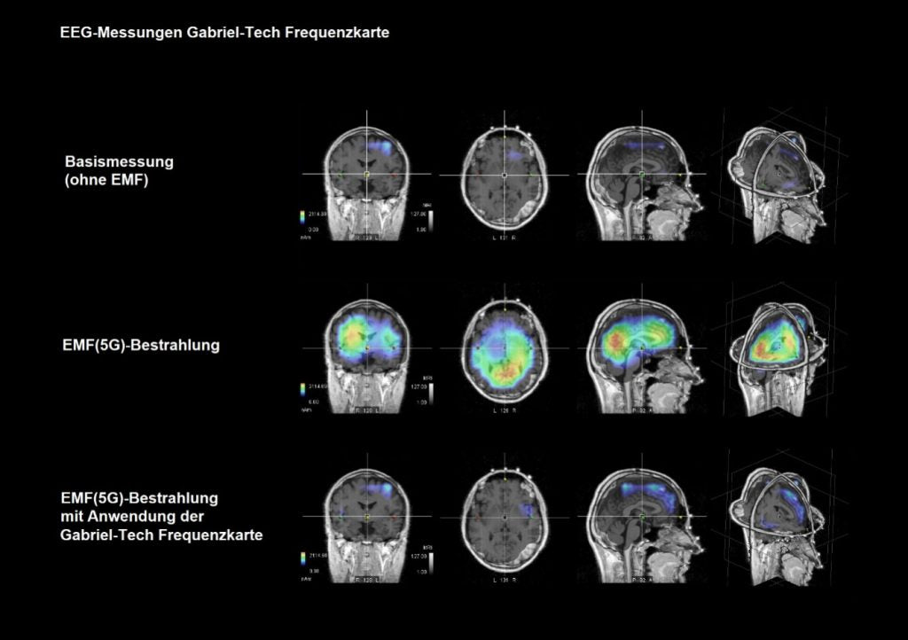 Gehirnaktivität mit Frequenzkarte und ohne