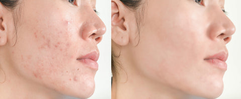 Salicylic Acid treatment for Acne