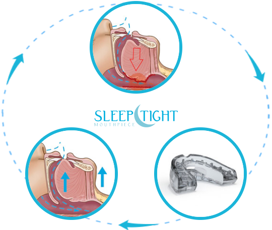 SleepTight Mouthpiece Review: Your Key To Sleep Tight