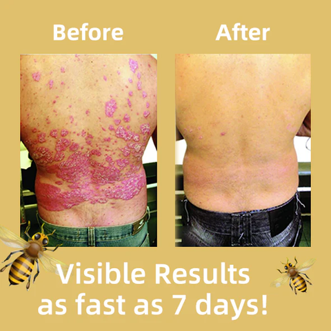 Oveallgo™ Bee Venom Psoriasis Treatment Cream