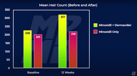 Ergebnisse Minoxidil vs. Dermaroller