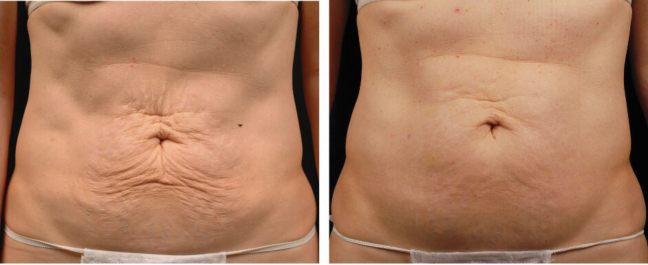 Thermage before and after abdomen