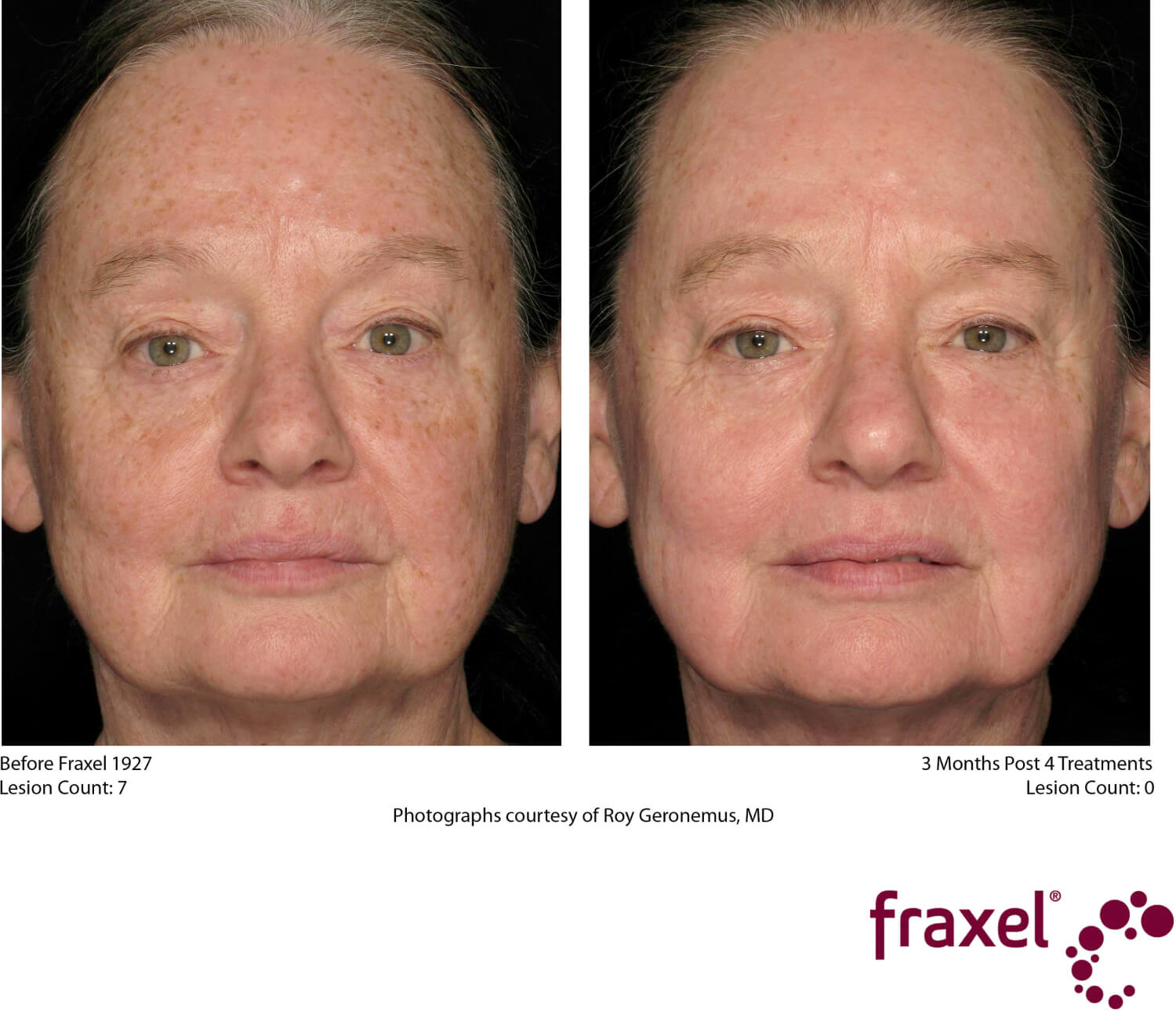 Fraxel Face Before and After Image