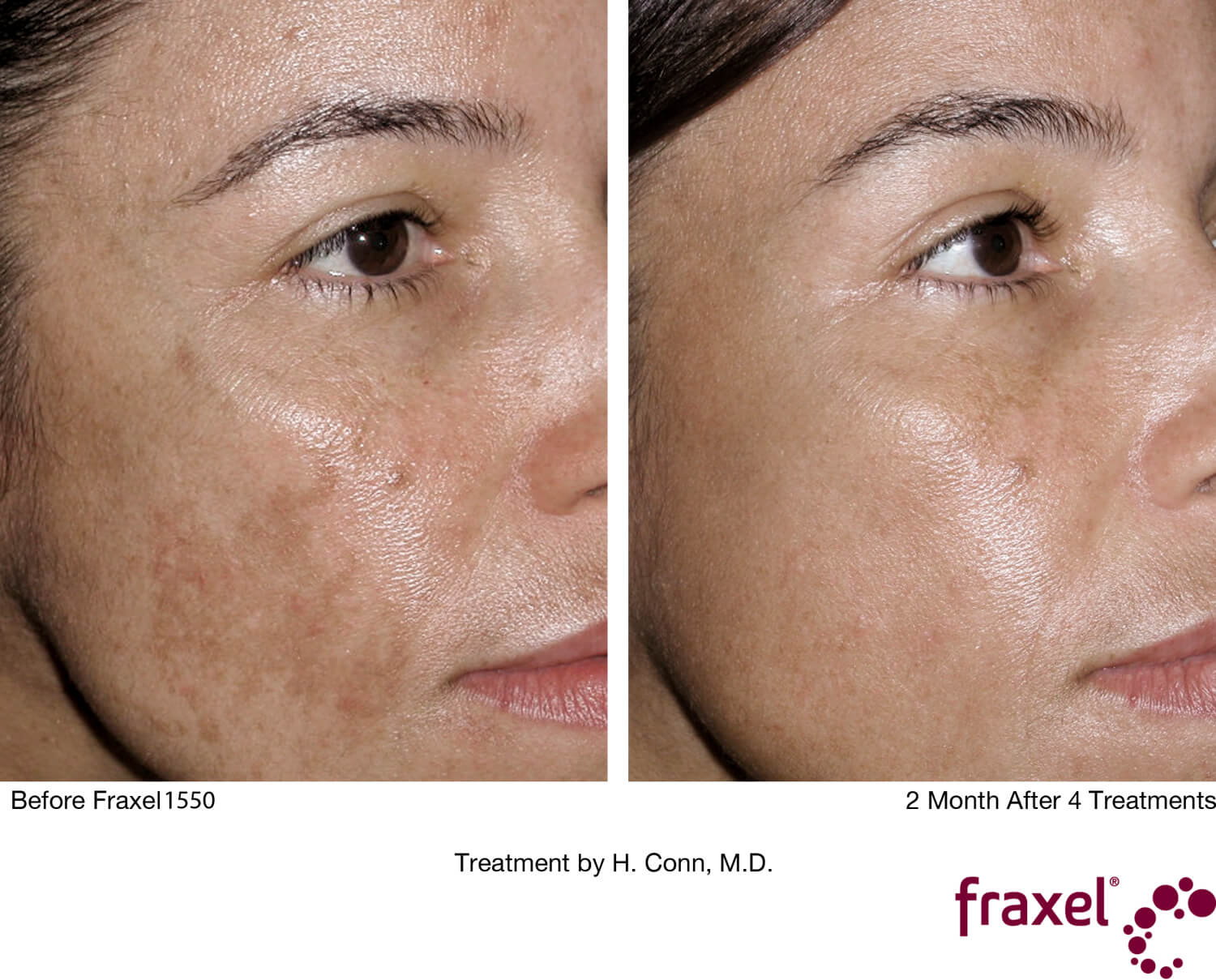 Fraxel Face Before and After Image