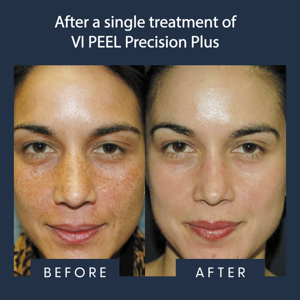 VI Peel Treatment before and after