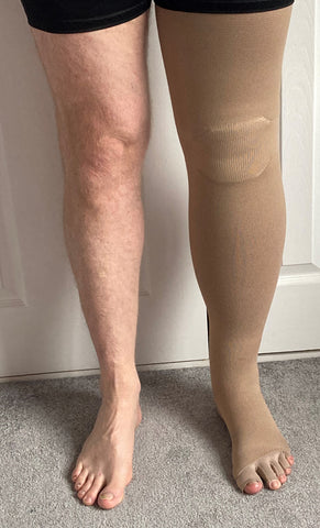 lymphoedema with stocking