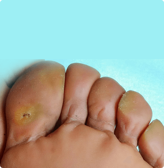 Why do we get Calluses on our hands and feet?