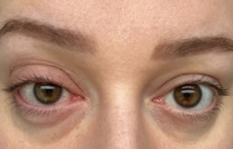 an allergic reaction to lash extension glue. the eyelid on the left eye is swollen and red