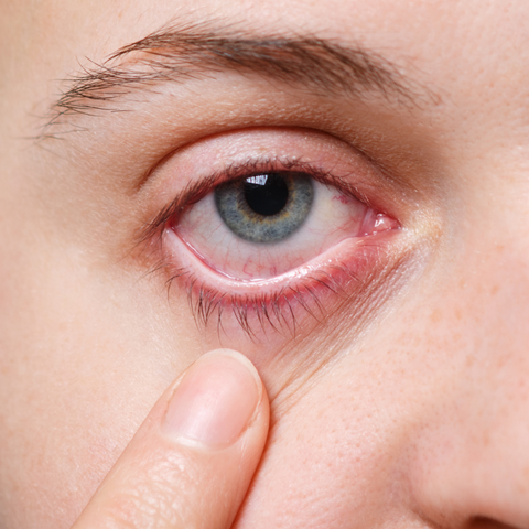Reduce eye redness before photos