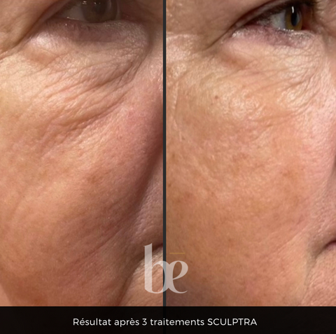 sculptra-avant-apres-clinique-be