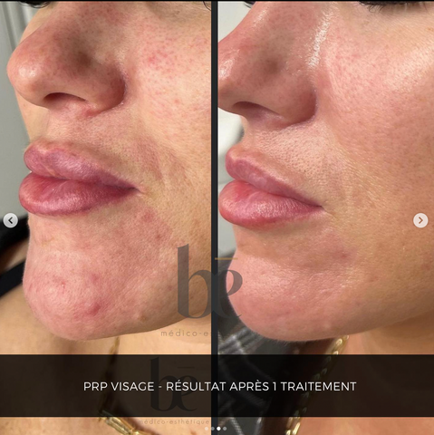 prp-visage-clinique-be-beloeil