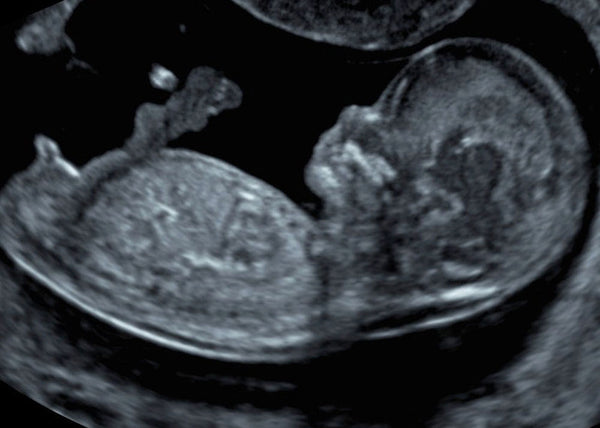Ultraschall des Babys im ersten Trimester
