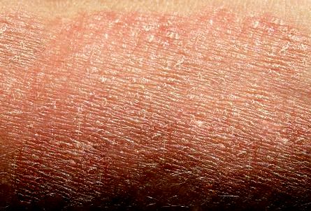 Causes of Eczema (Atopic Dermatitis)