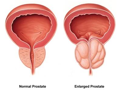 Common Prostate Problems