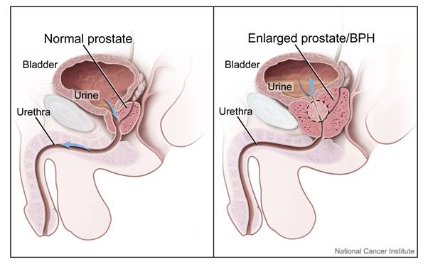 Common Prostate Problems