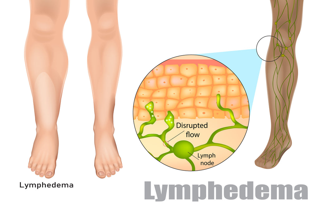 Lymphedema – Causes and Practical Help