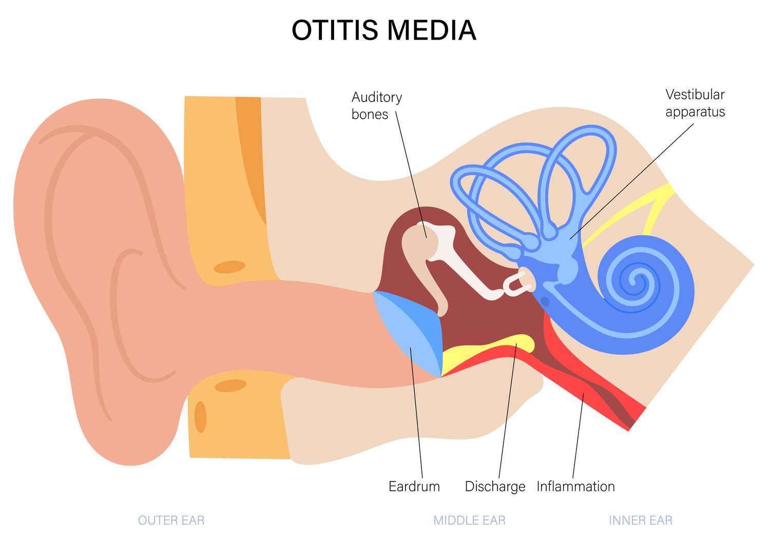 Otitis Media (Ear Infection)