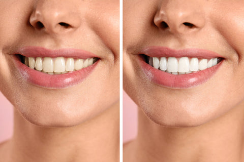 Stained or Yellow Teeth Before and After Teeth Whitening