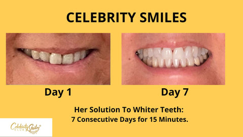 Teeth Whitening Before and After. Day 1 and Day 7 Results.