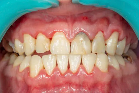 Periodontitis Advanced Gum Disease