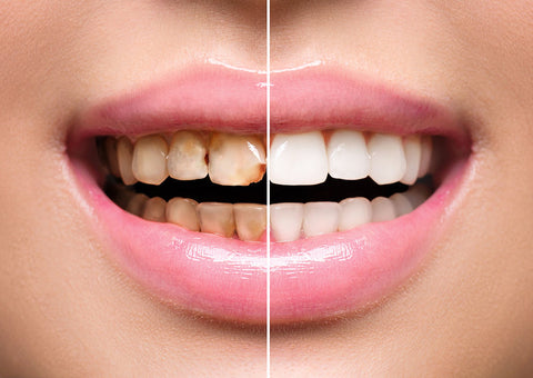 Teeth Whitening Safe Around Dental Crowns, Veneers, Bonding and Restorations