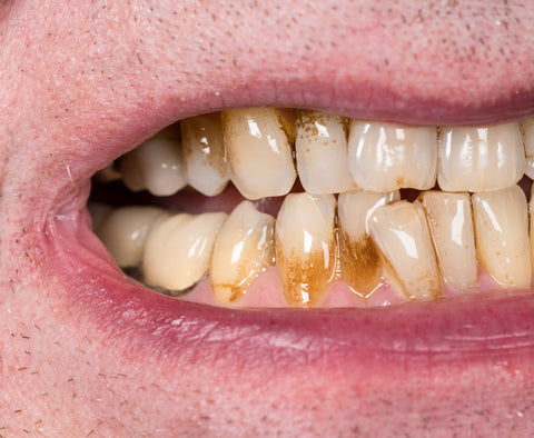 Tobacco Stained Teeth