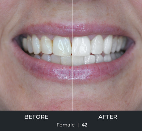 Before and after photograph of a 42-year-old woman's teeth. The woman's teeth are significantly whiter in the "after" section of the photograph.