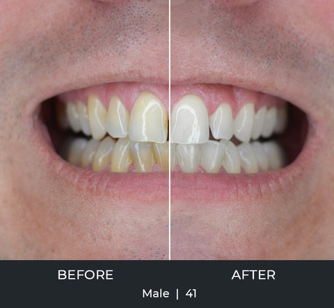 Before and after photograph of a 41-year-old man's teeth. The man's teeth are significantly whiter in the "after" section of the photograph.