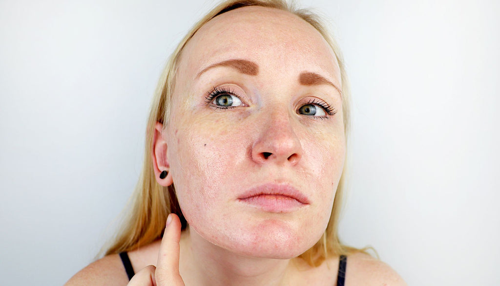 Redrina comment se débarrasser de l'acné pour une peau grasse 