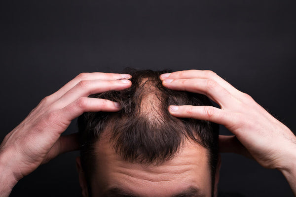 man struggling with hair loss